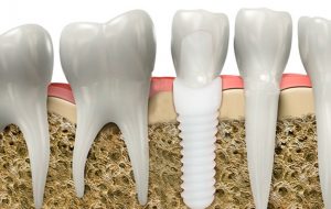 implantes-zirconio